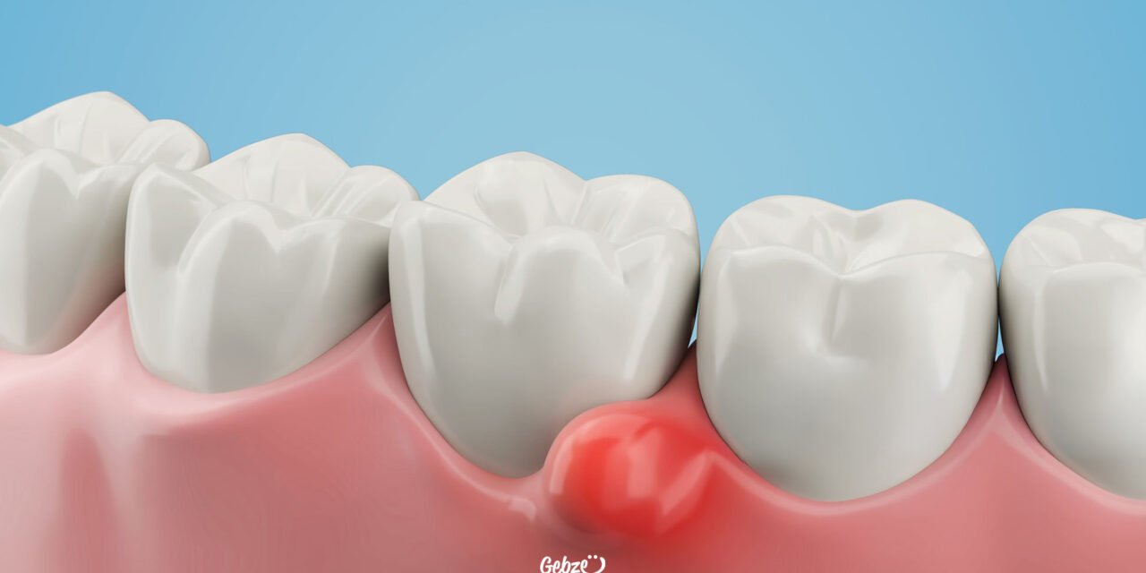 İltihaplı Diş Ağrısı