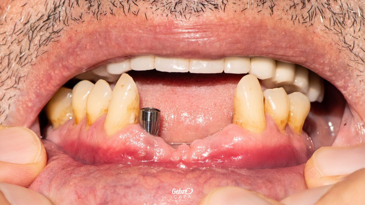 Gebze İmplant Diş Tedavisi