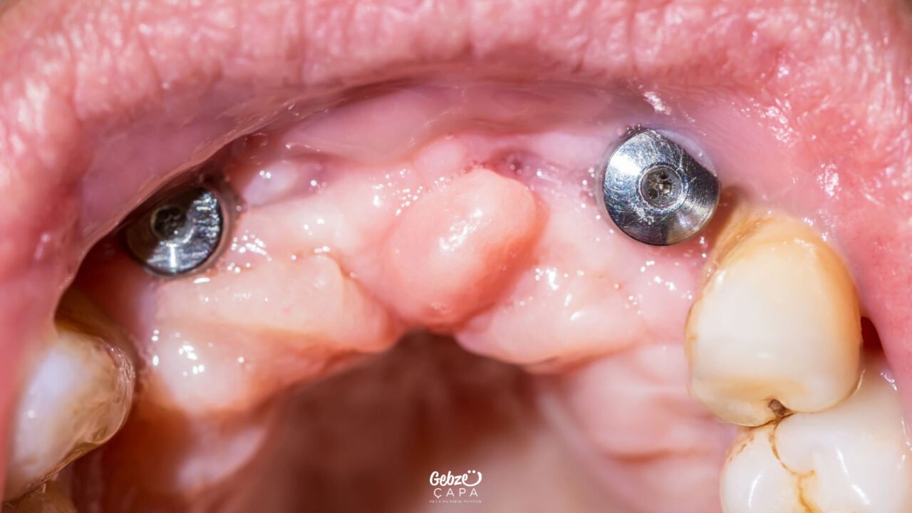 Gebze İmplant Diş Tedavisi