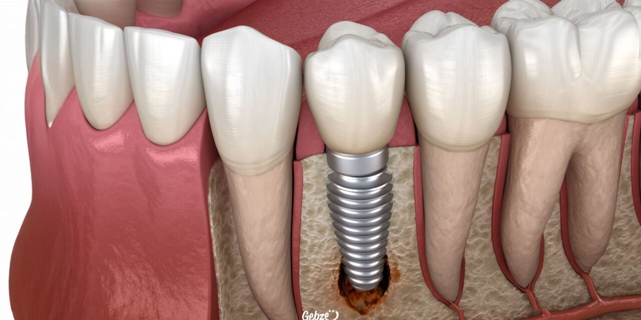 Gebze İmplant Diş Tedavisi
