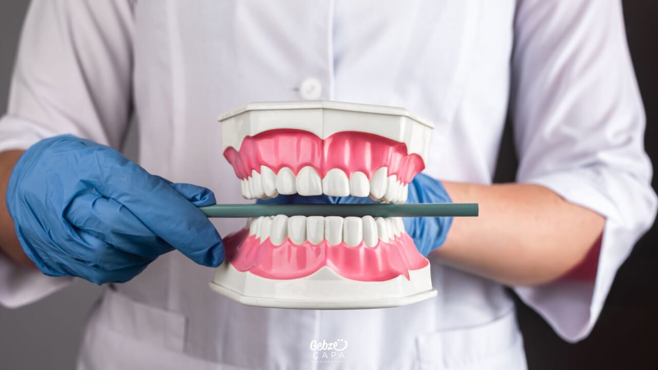 What is Malocclusion