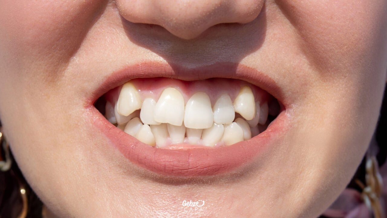 What is Malocclusion