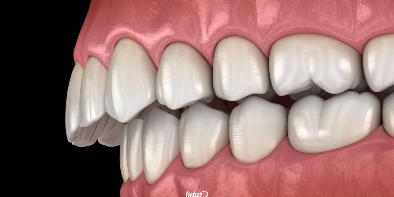 Maloklüzyon Nedir?