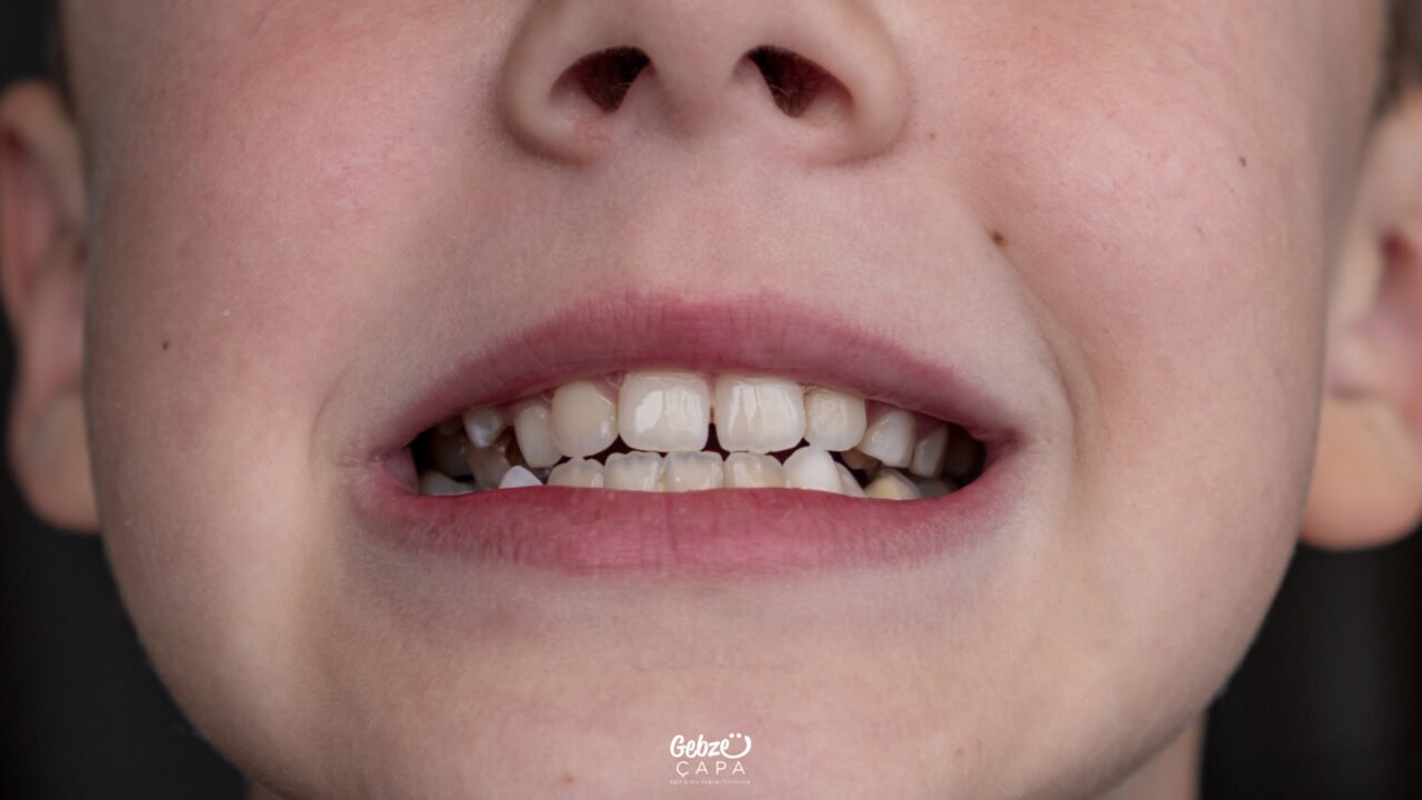 What is Malocclusion