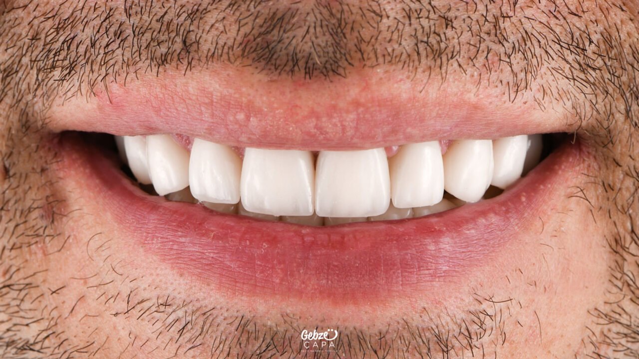 Differences Between Emax and Zirconium Crowns