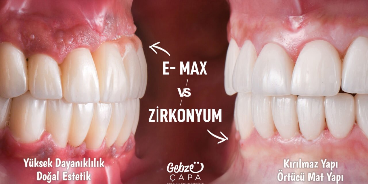 Emax ile Zirkonyum Kaplama Farkları