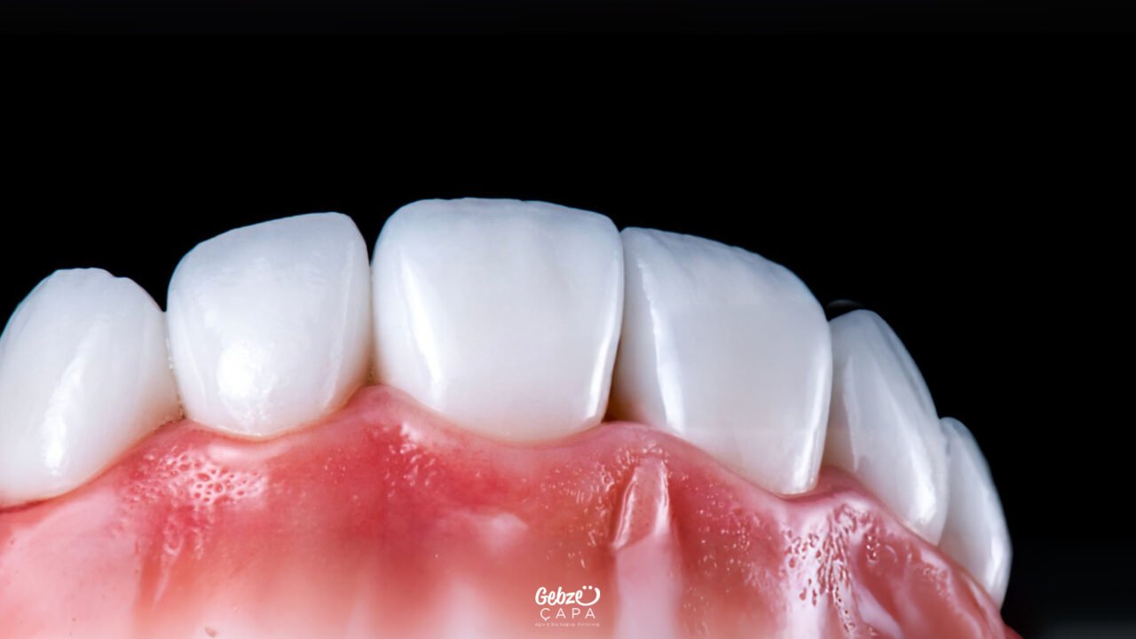 Differences Between Emax and Zirconium Crowns