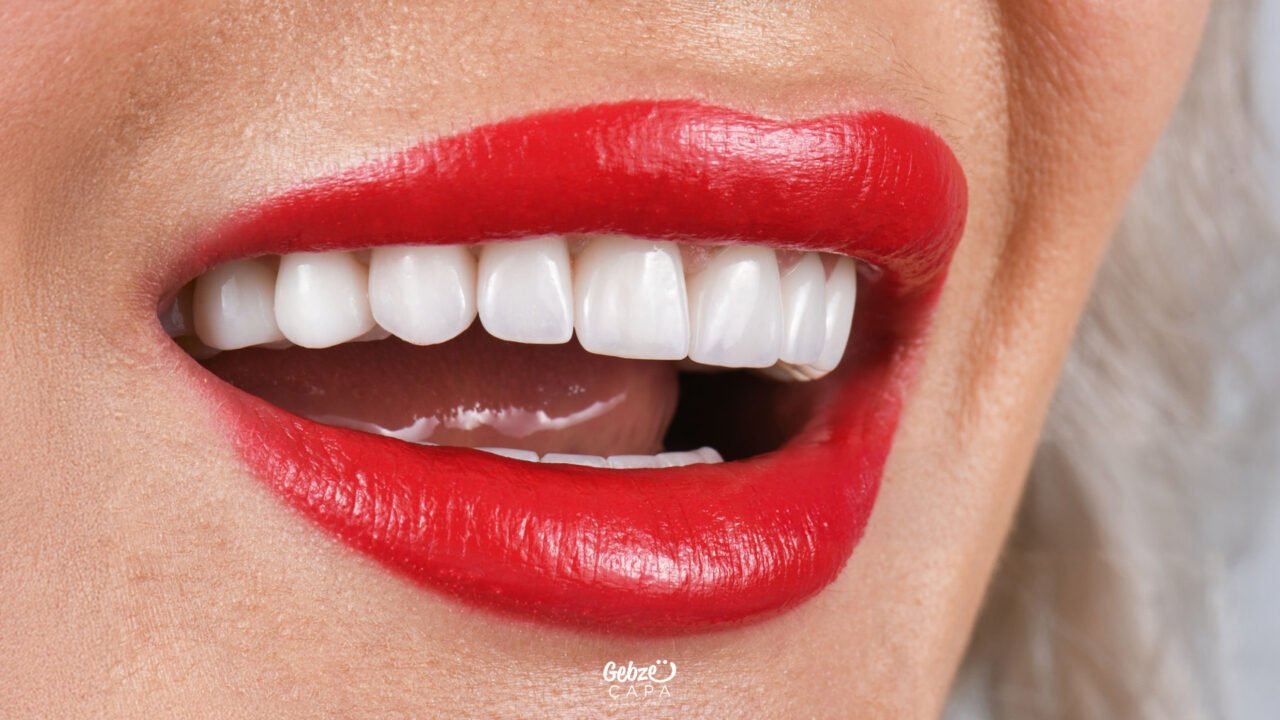 Differences Between Emax and Zirconium Crowns