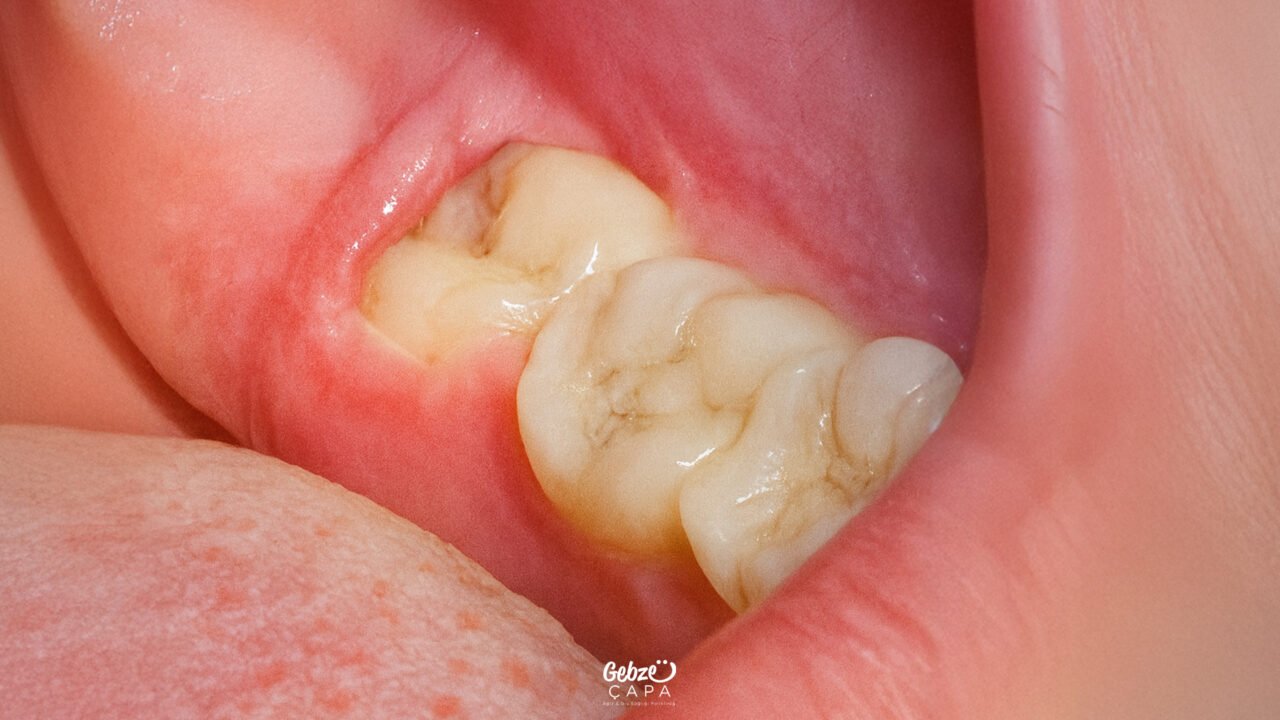 Impacted Tooth Extracted