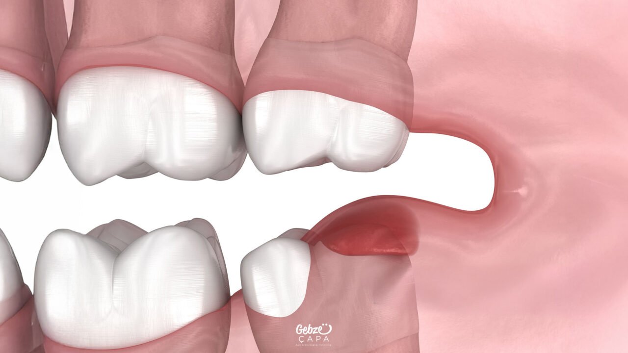Impacted Tooth Extracted