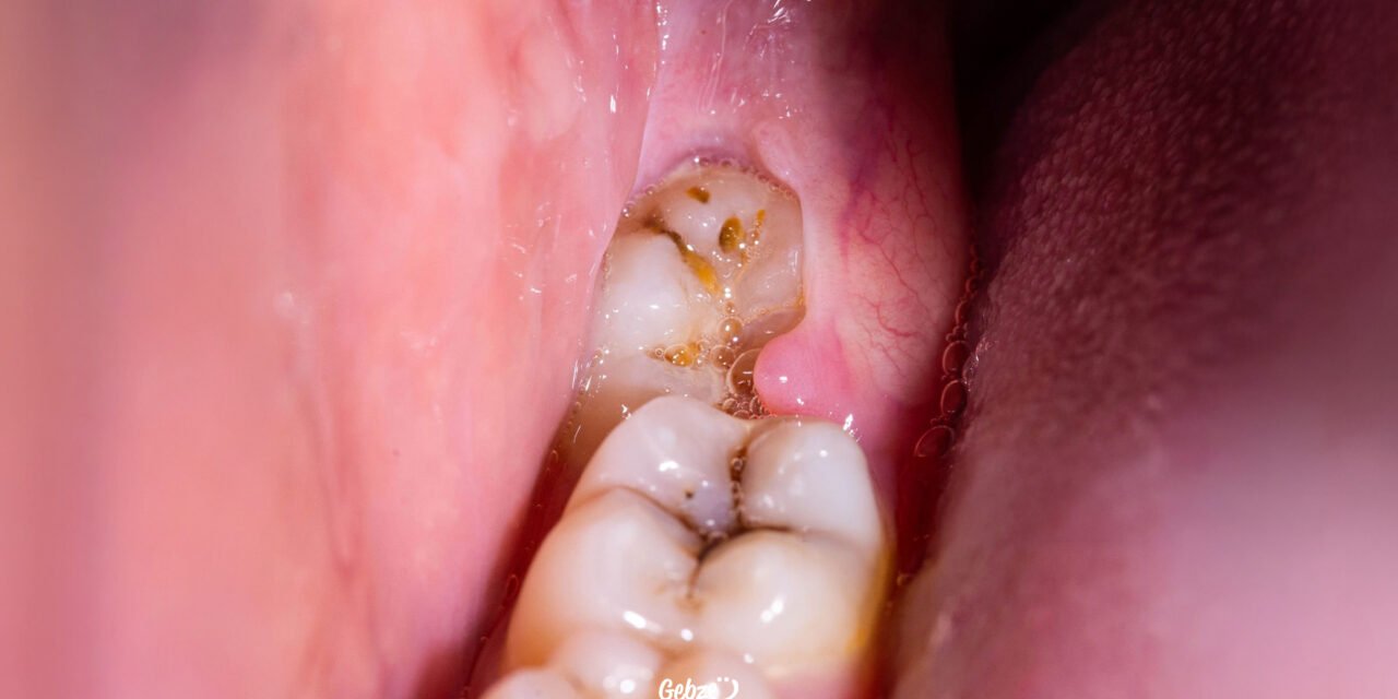 Gömülü Diş Çekimi Nasıl Yapılır?