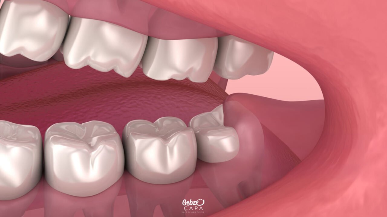 Impacted Tooth Extracted