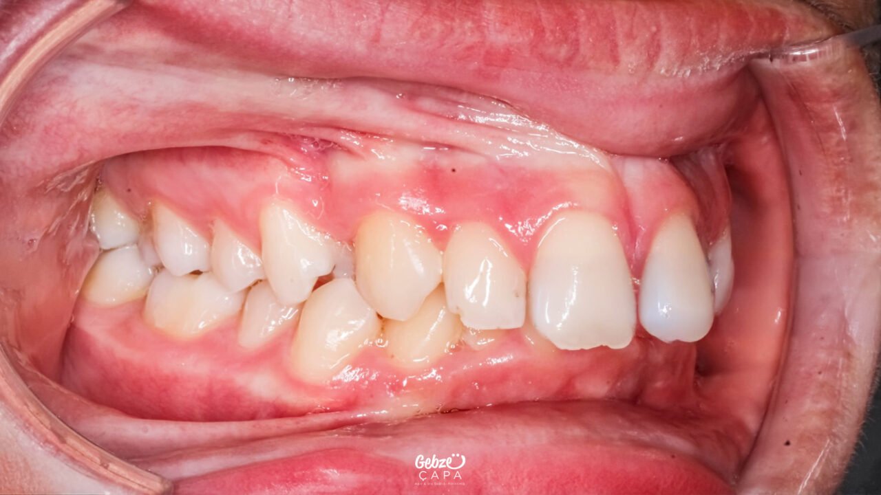 Is Diastema Only an Aesthetic Issue?