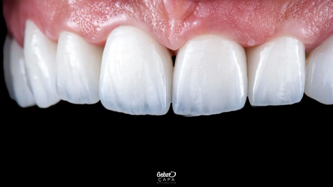 How Should Zirkonyum Veneers Be Cared For