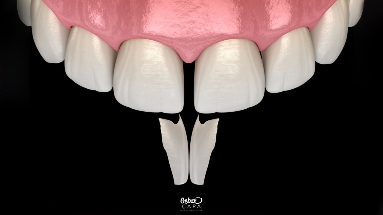 Diastema Treatment Options