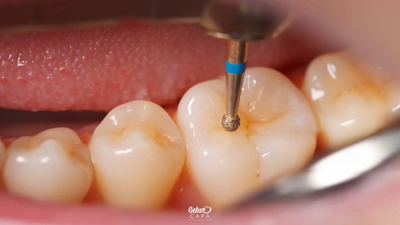 What Is Pulp Capping