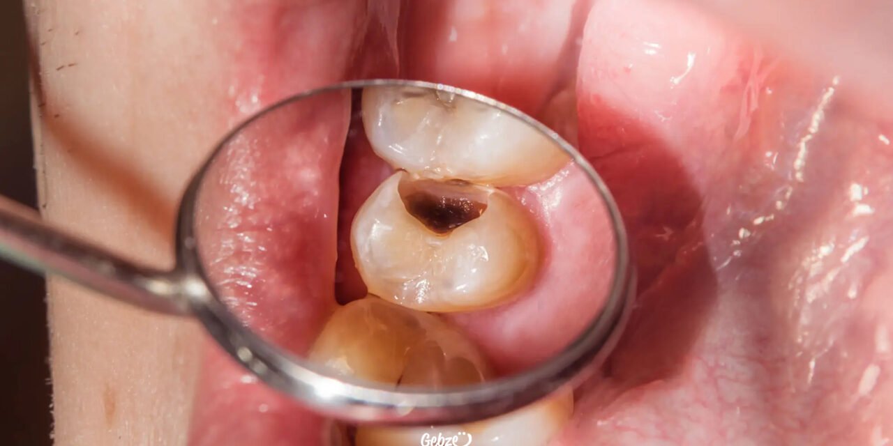 What Is Pulp Capping?