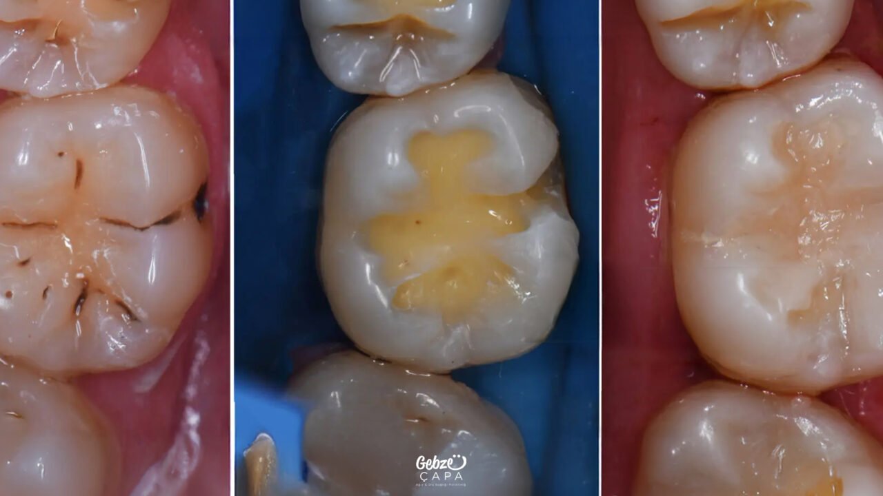 What Is Pulp Capping