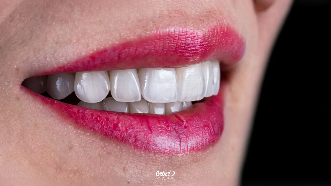 Yaprak Zirkonyum Nedir