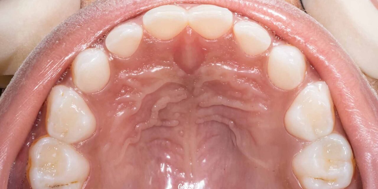 Why Does the Palate Swell?