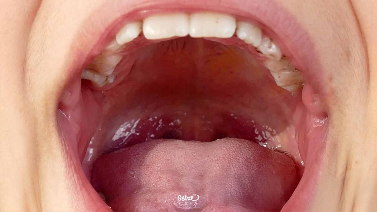 Why Does the Palate Swell