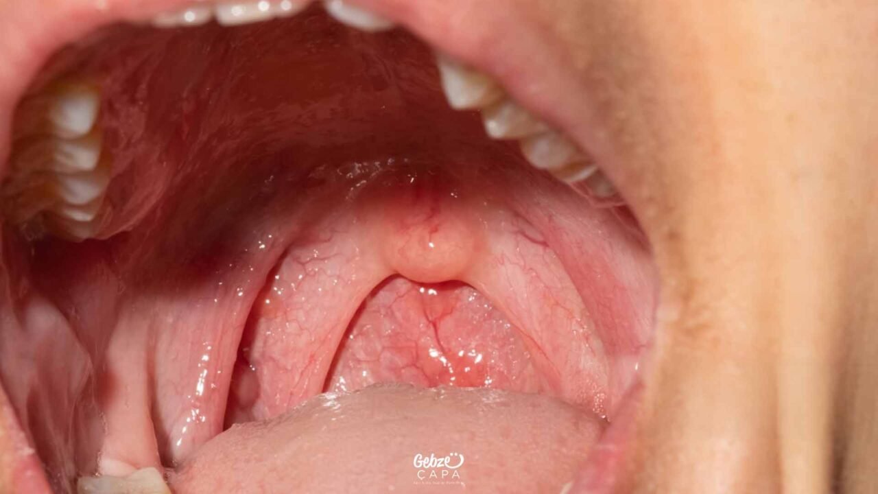 Why Does the Palate Swell