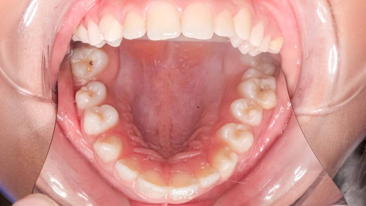 Why Does the Palate Swell