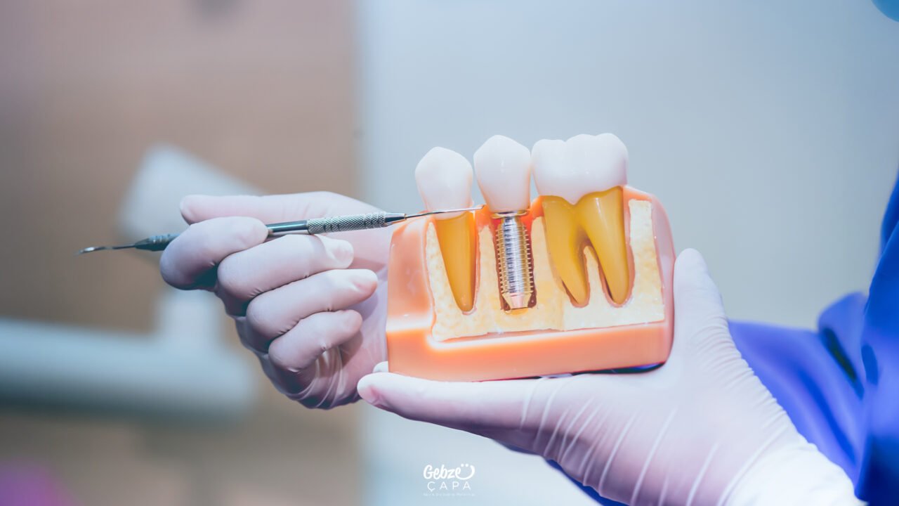 Dental Implant Treatment in Turkey