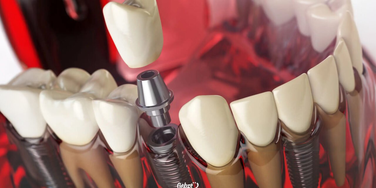 Gebze İmplant Tedavisi