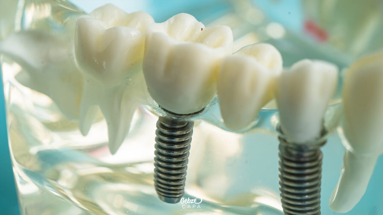 Dental Implant Treatment in Turkey