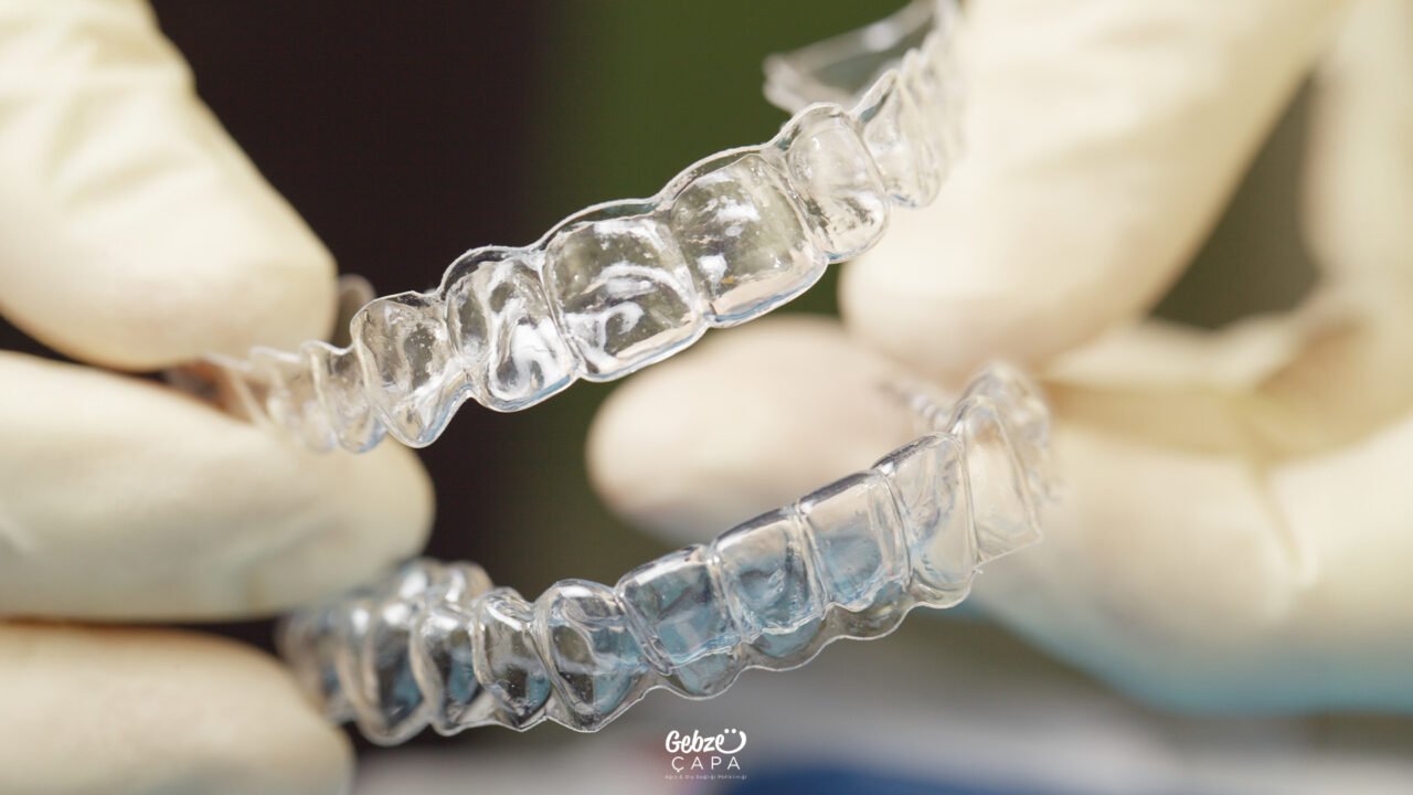 Braces or Clear Aligners?