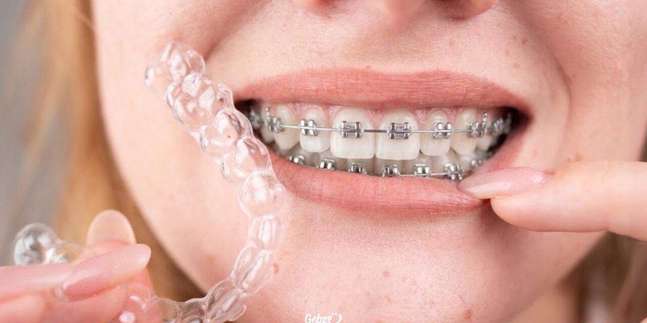 Braces or Clear Aligners?