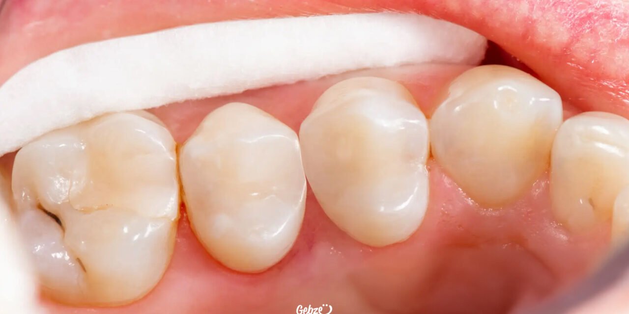 What is Composite Filling?