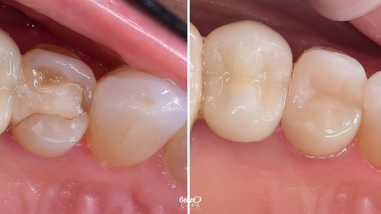 What is Composite Filling