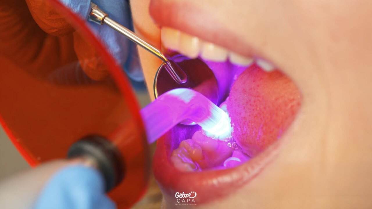 Kompozit Dolgu Nedir