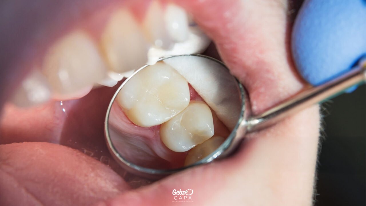 What is Composite Filling