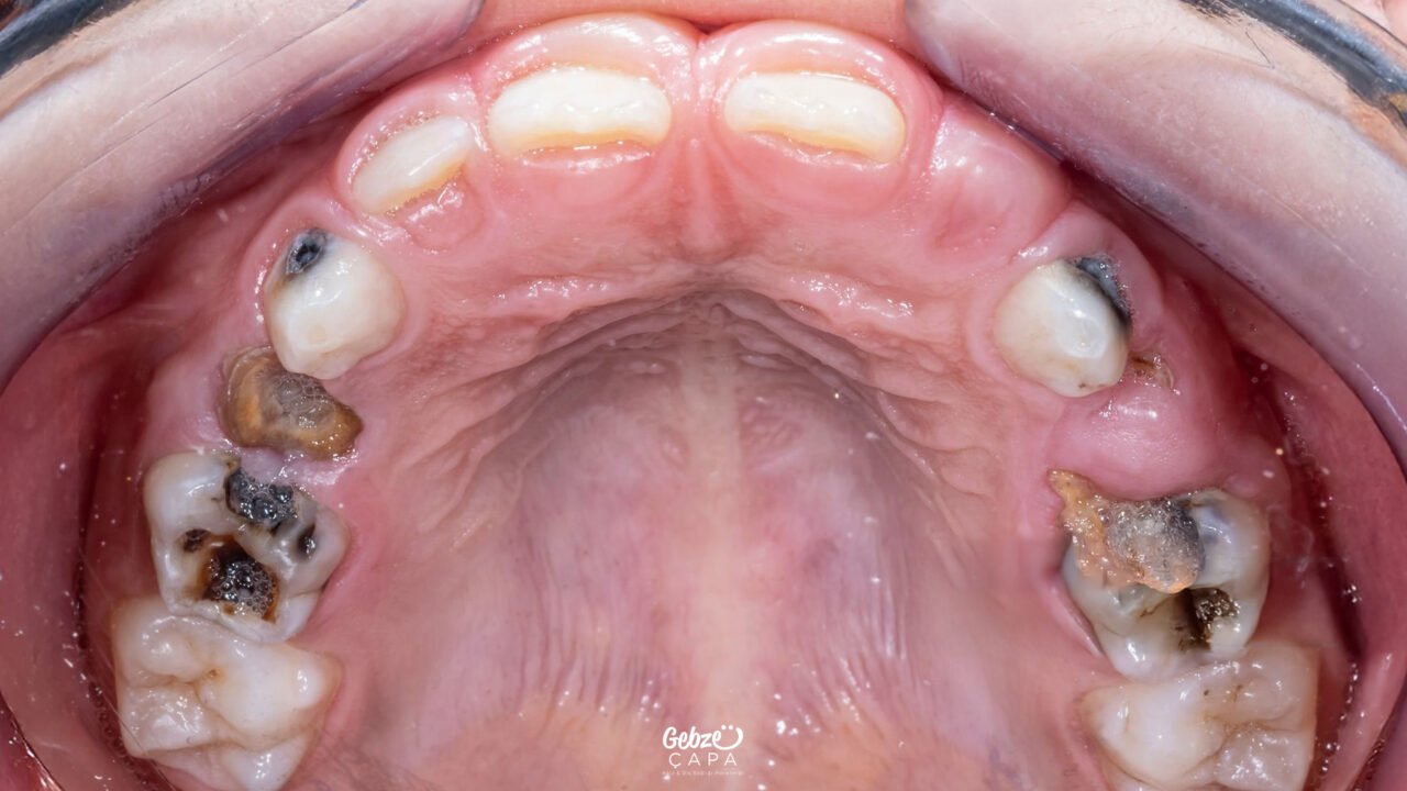 Root Canal Treatment in Primary Teeth