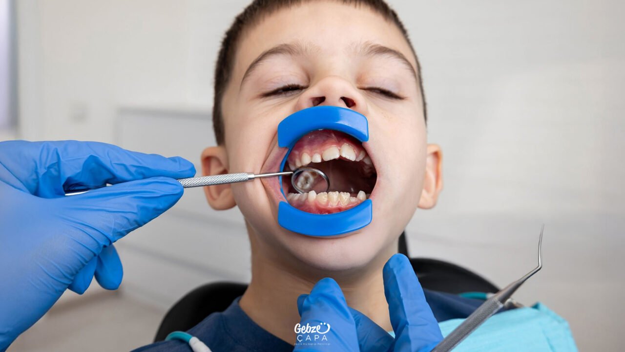 Root Canal Treatment in Primary Teeth