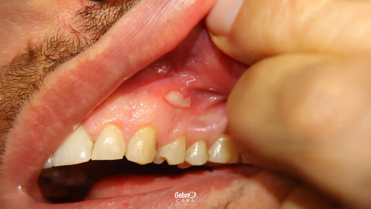 What Is a Mouth Sore
