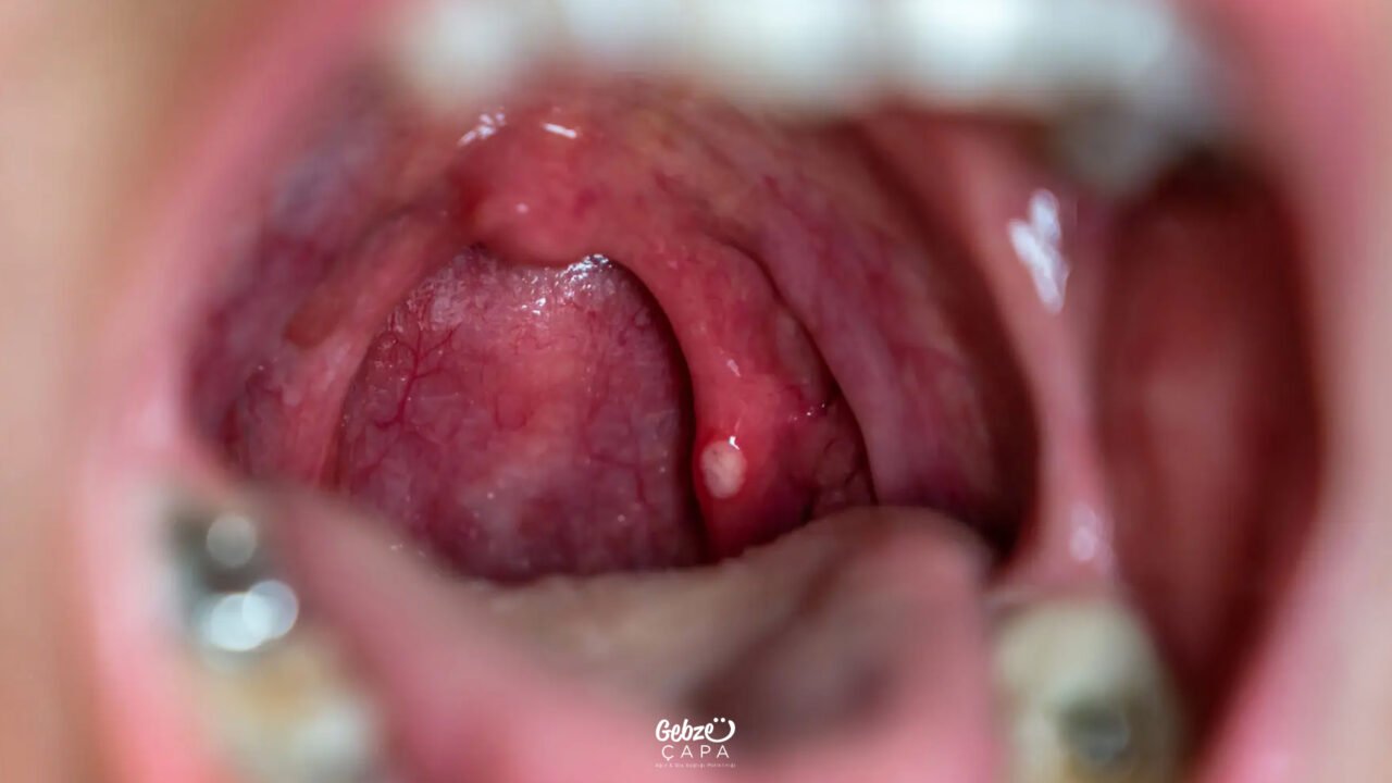 What Is a Mouth Sore